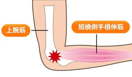 テニス肘、野球肘